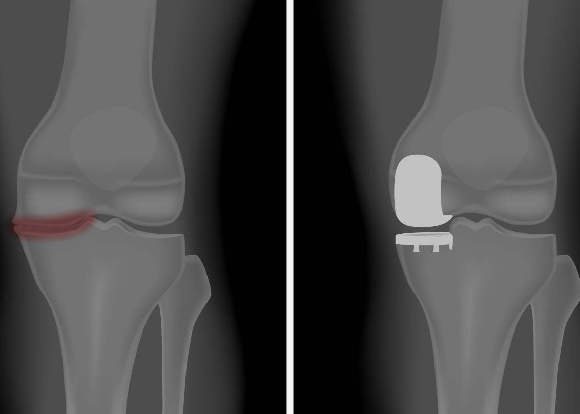 Partial & Total Knee Replacement