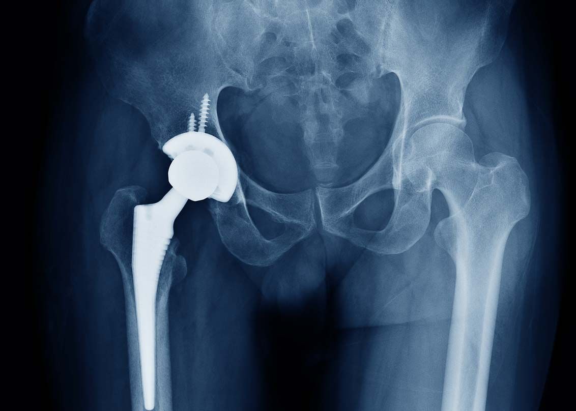 X-ray scan image of hip joints with orthopedic