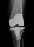 Total Knee Replacement x-ray