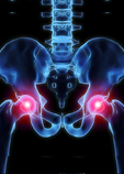 Total Hip Replacement X-ray