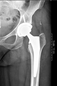 x-ray hip bone w/screw