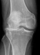 knee arthritis X-Ray