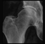 normal hip X-Ray