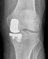 Partial Knee Replacement – Dearborn & Associates