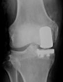 Partial Knee Replacement x-ray