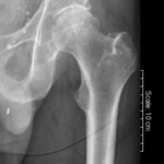 xray hip bone