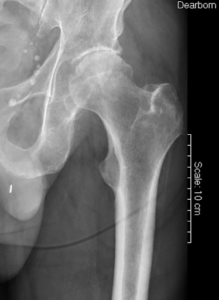 xray hip bone